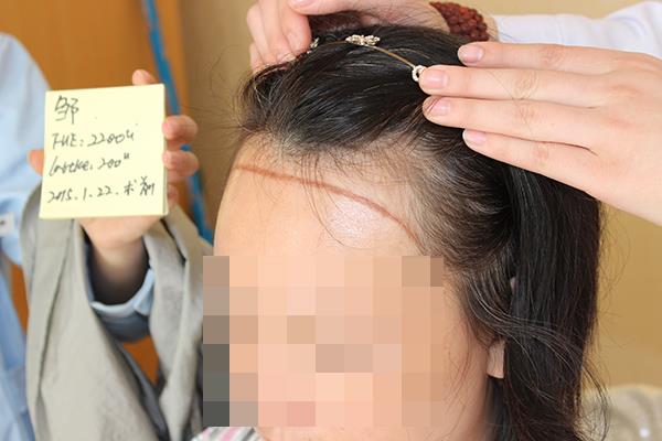 掉头发很厉害怎么办 掉头发和脱发有什么区别