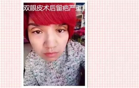 这些都是割双眼皮失败案例图片,看完你还敢割双眼皮吗?
