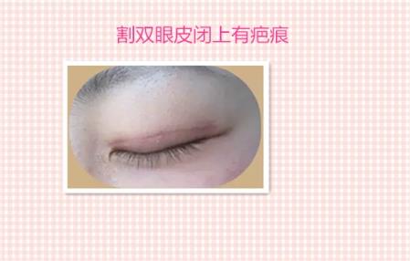 这些都是割双眼皮失败案例图片,看完你还敢割双眼皮吗?