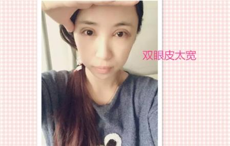 这些都是割双眼皮失败案例图片,看完你还敢割双眼皮吗?