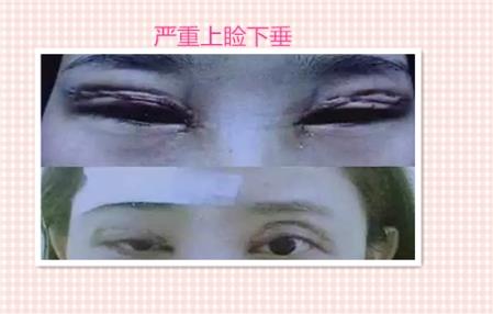 这些都是割双眼皮失败案例图片,看完你还敢割双眼皮吗?
